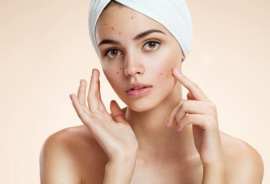 Lady with Acne 
